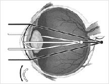 Astigmatism - Refractive Conditions