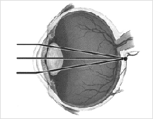 Hyperopia - Refractive Conditions