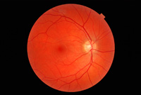 Retinal Photograph
